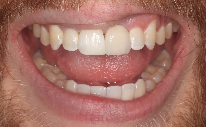 Dental implants - Case 1 after