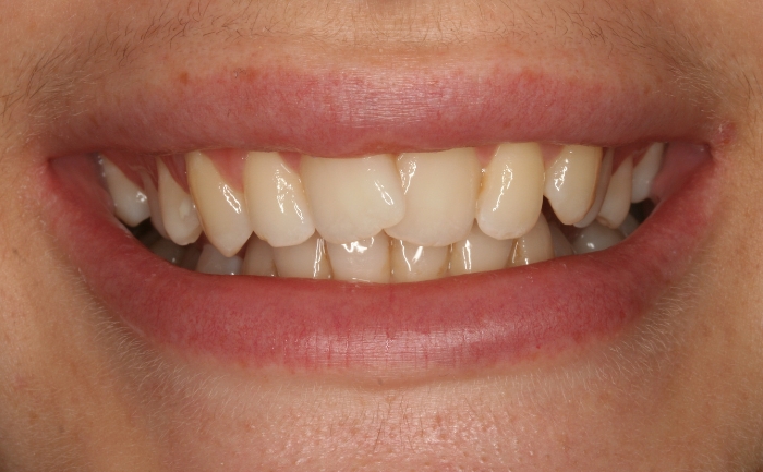 Teeth Straightening - Case 1 before