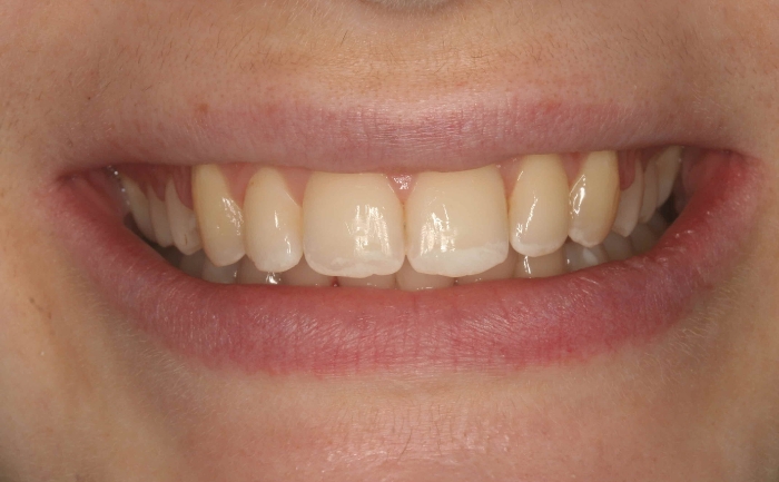 Teeth Straightening - Case 1 after