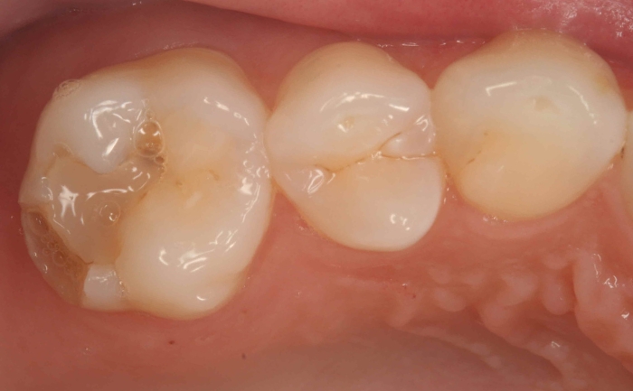 White Filling - Case 1 before