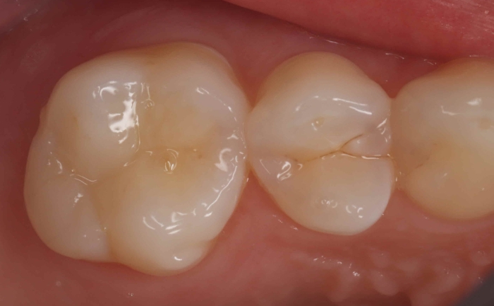 White Filling - Case 1 after