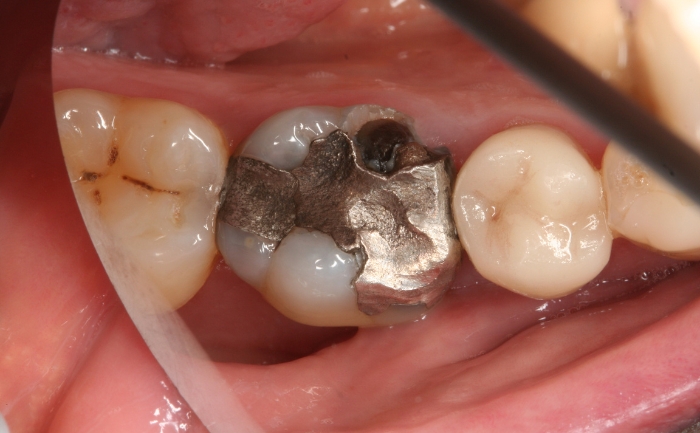 CEREC - Case 1 before
