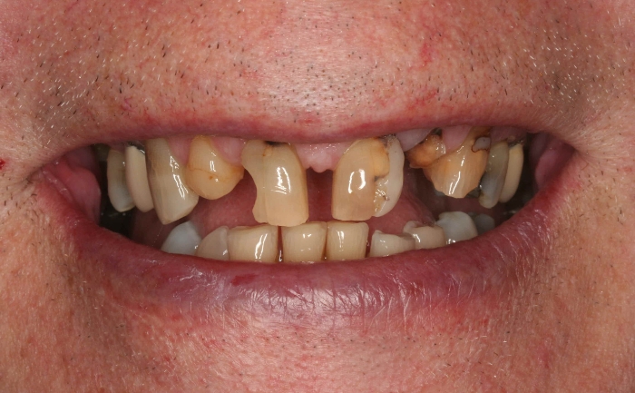Aesthetic Dentures - Case 1 before