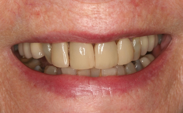 Porcelain Veneers - Case 3 before