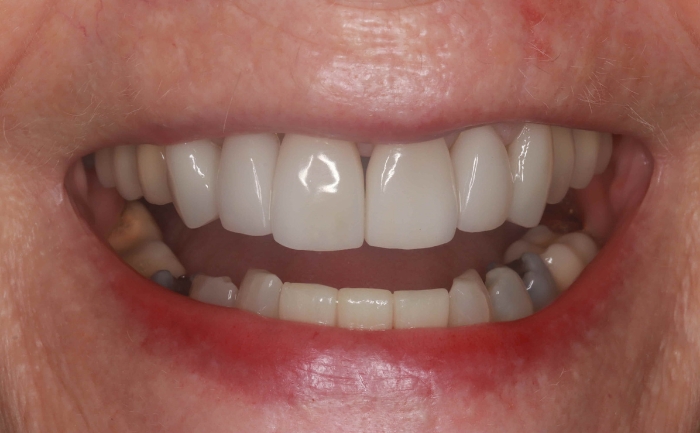 Porcelain Veneers - Case 3 after