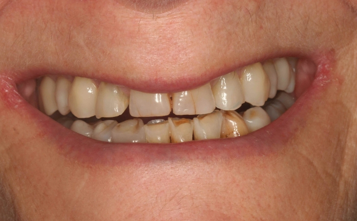 Composite Bonding - Case 1 before