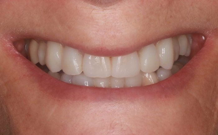 Composite bonding - case 1 after
