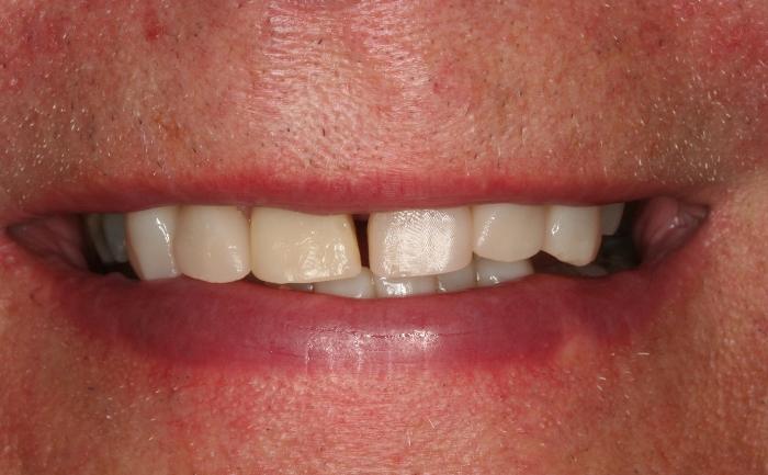 Composite bonding - Case 2 after