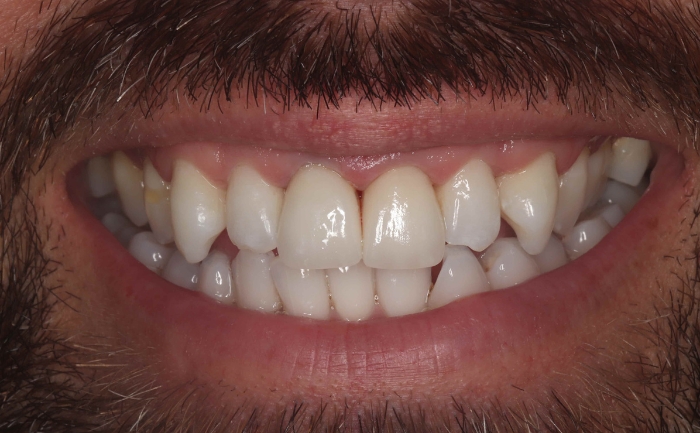 Porcelain Veneers - Case 4 after