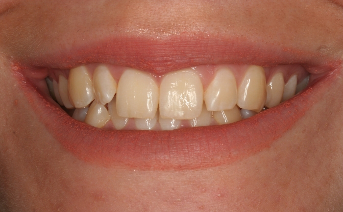 Porcelain Veneers - Case 5 before
