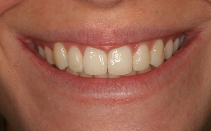 Porcelain Veneers - Case 5 after