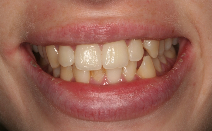 Porcelain Veneers - Case 6 before
