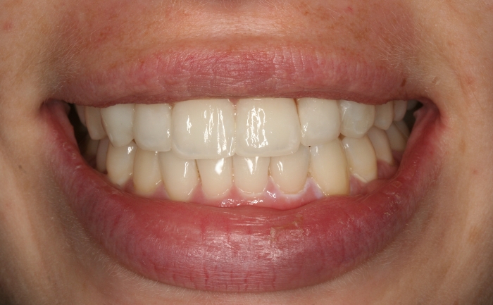 Porcelain Veneers - Case 6 after