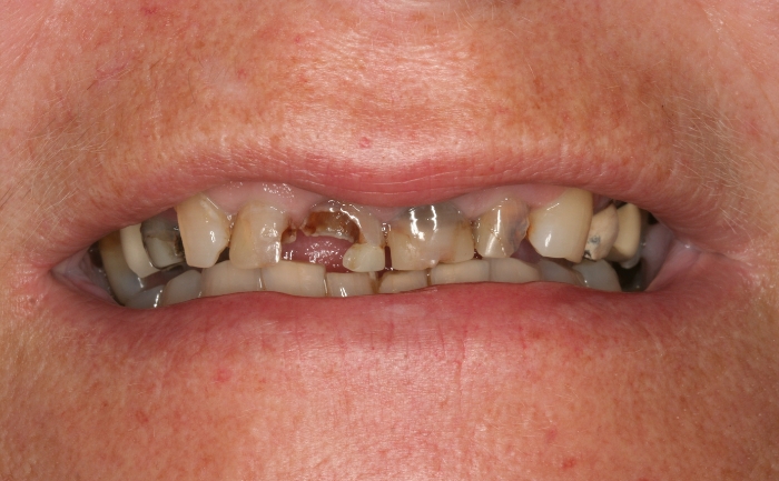 Dental implants - Case 2 before