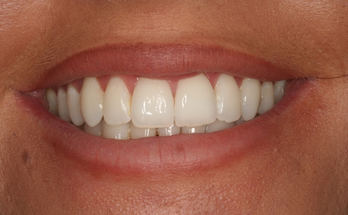 Teeth Straightening - Case 2 after