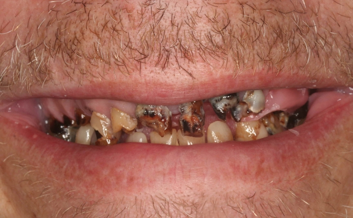 Dental Implants - Case 3 before