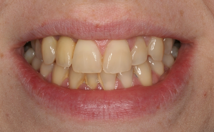 Tooth Whitening - Case 1 before
