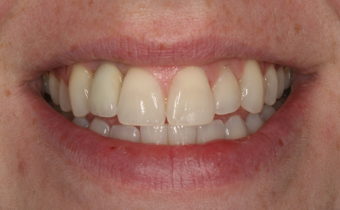 Tooth Whitening - Case 1 after