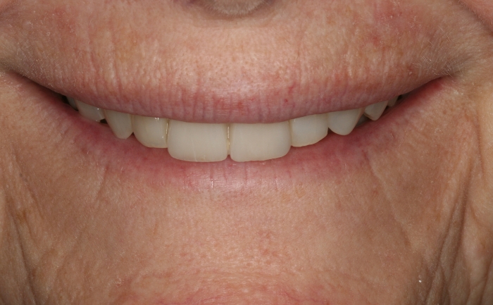 Porcelain Veneers - Case 7 after