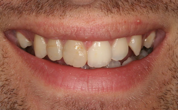 Composite Bonding - Case 3 before