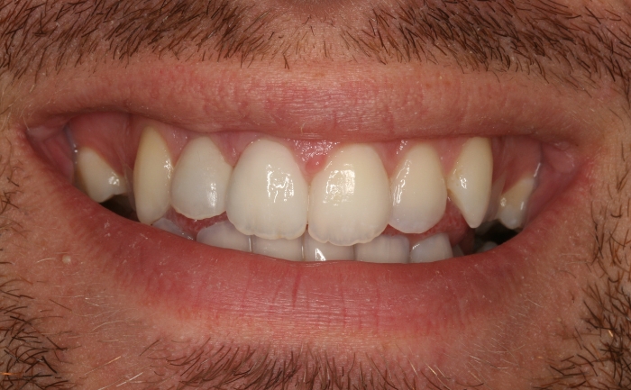 Composite Bonding - Case 3 after